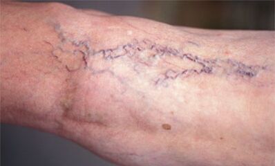 varikozu vēnu ārstēšanas metodes uz kājām