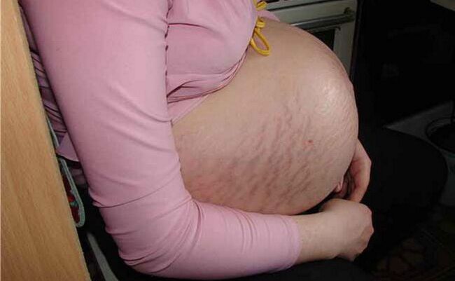 Varikozu vēnu cēloņi grūtniecības laikā