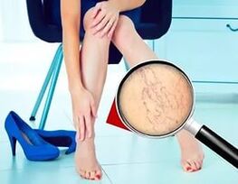 Simptomi ir atkarīgi no varikozu vēnu rakstura un stadijas