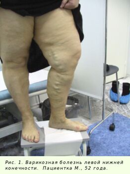 Varikozas vēnas ir jāārstē, lai apturētu procesu