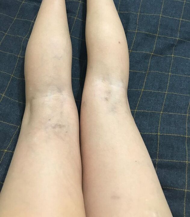 varikozu vēnu izpausmes uz kājām